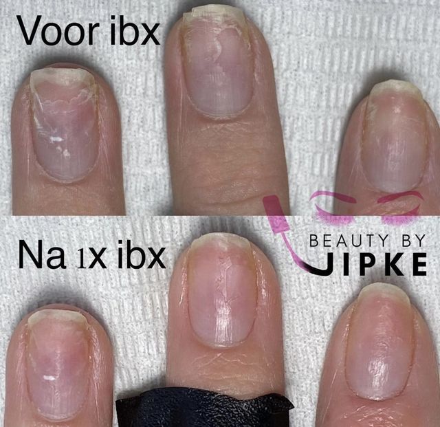 IBX behandeling voorbeeld