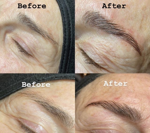 Brow lift voorbeeld 3